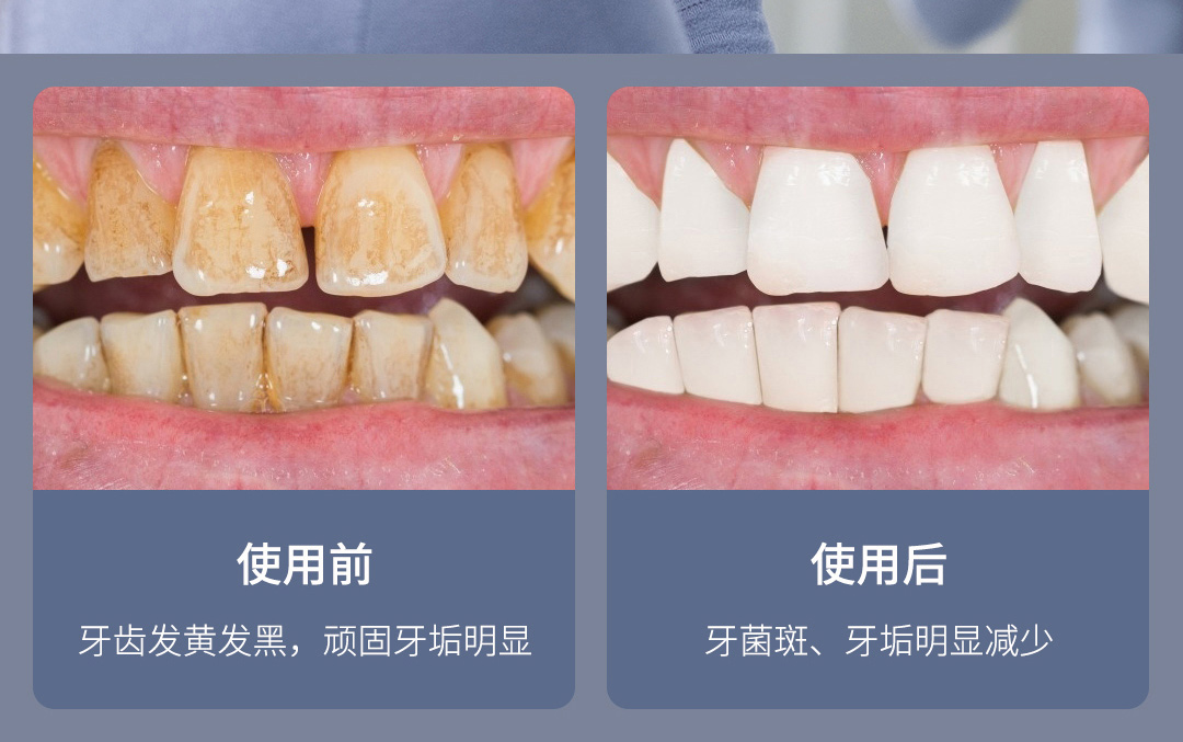 product_奇妙_素诺智能可视超声波洁牙仪T11Pro