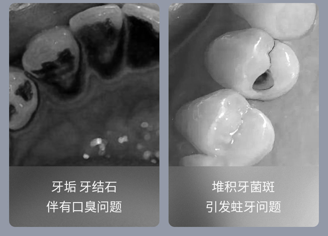 product_奇妙_素诺智能可视超声波洁牙仪T11Pro